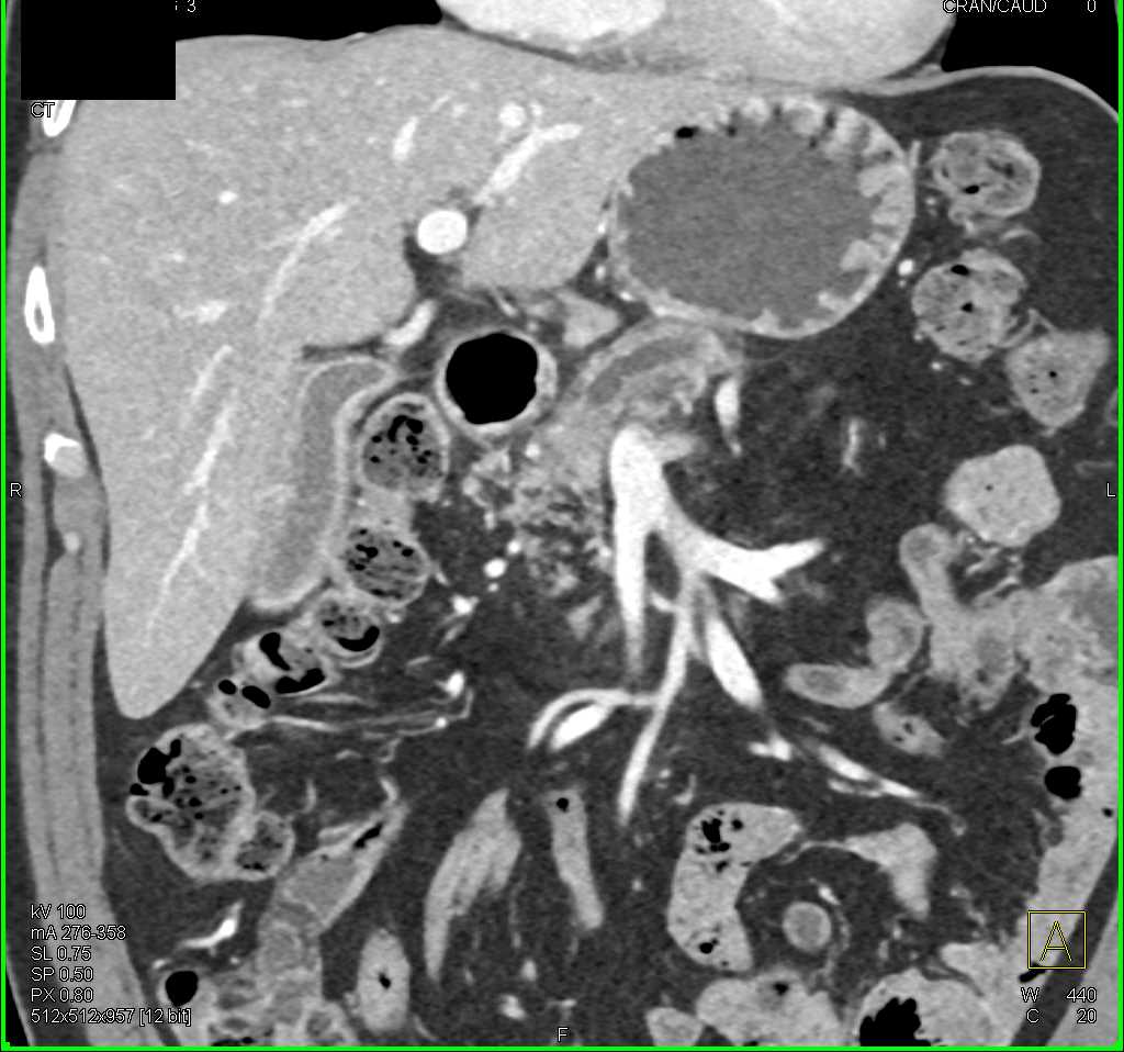 Carcinoma Pancreas with Dilated Pancreatic Duct - CTisus CT Scan