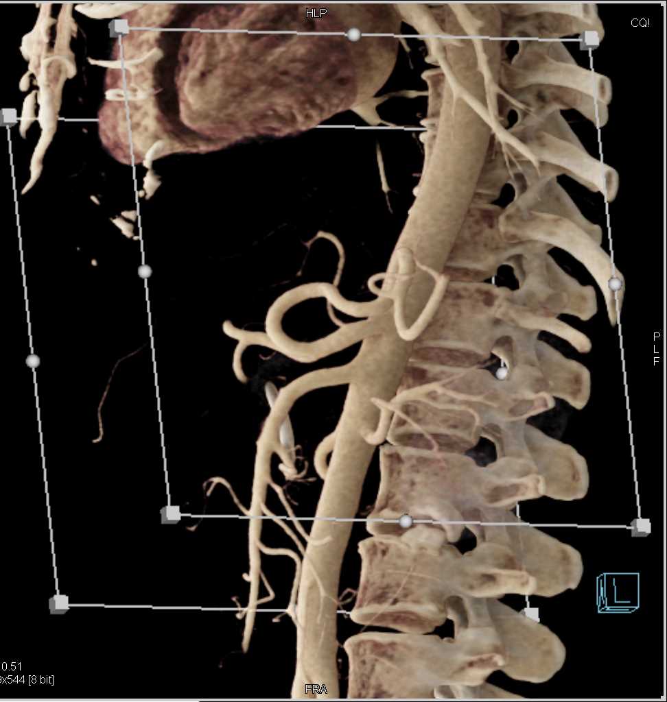 Carcinoma Pancreas with Dilated Pancreatic Duct - CTisus CT Scan