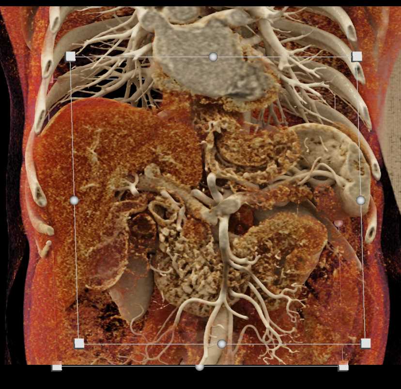 Carcinoma Pancreas with Dilated Pancreatic Duct - CTisus CT Scan