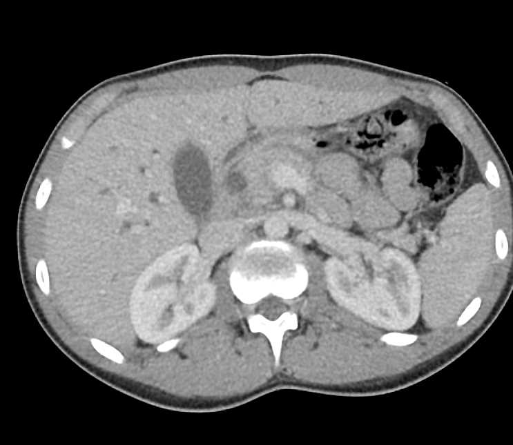 Carcinoma of the Head of the Pancreas - CTisus CT Scan