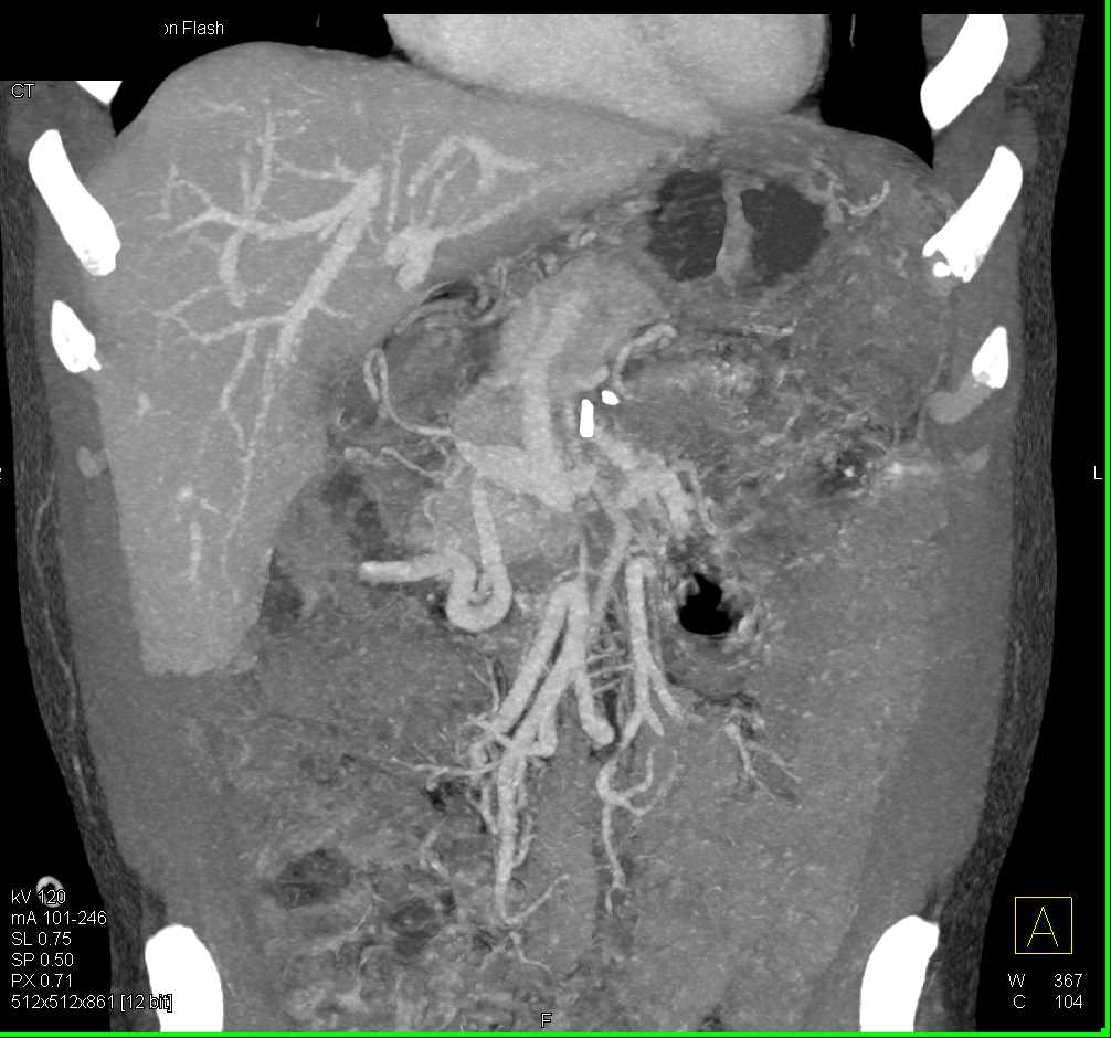 Carcinoma of the Pancreas with Vascular Invasion - CTisus CT Scan