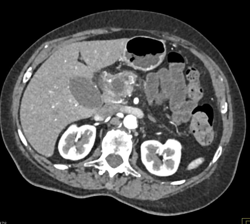 Adenocarcinoma Head of Pancreas - CTisus CT Scan