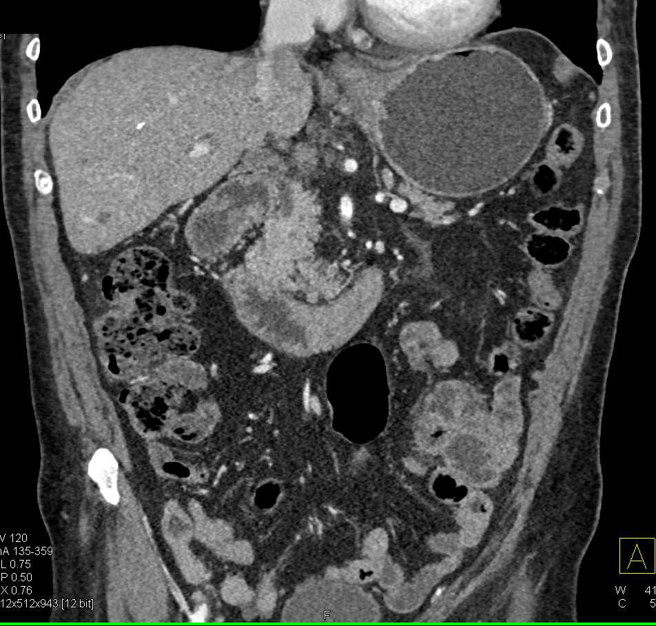 Pancreas Adenocarcinoma - CTisus CT Scan