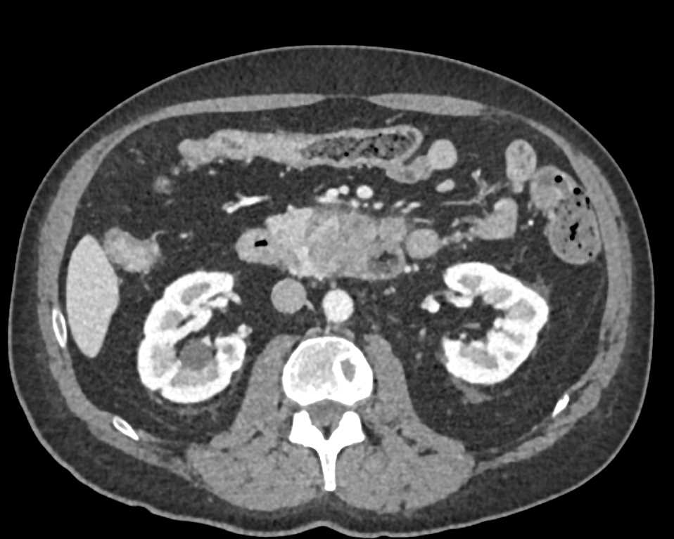 Adenocarcinoma Pancreas - CTisus CT Scan