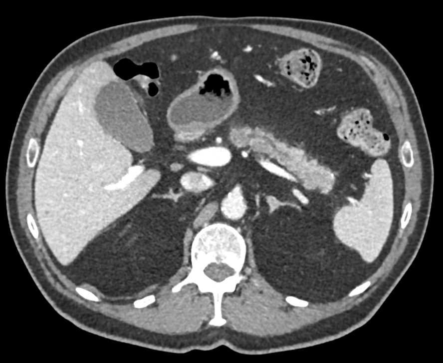 Adenocarcinoma in the Body of the Pancreas - CTisus CT Scan