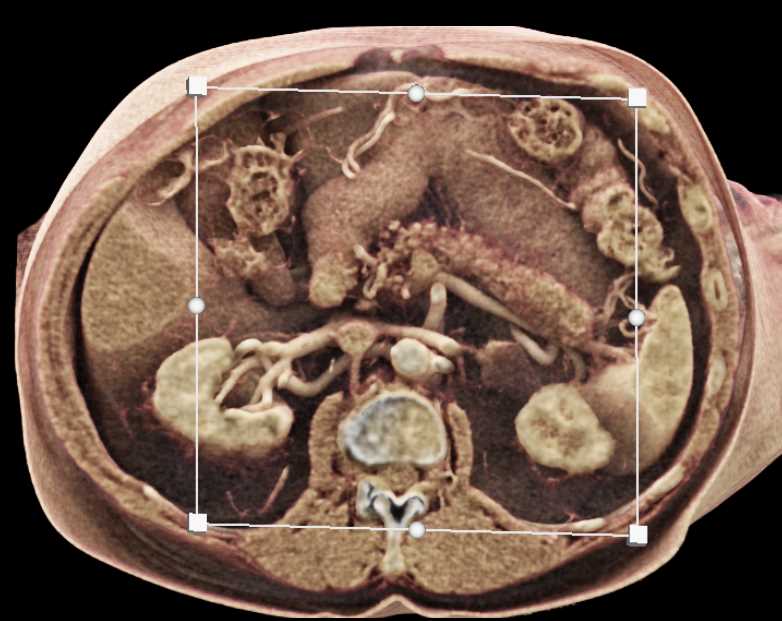 Subtle Tumor in the Body of the Pancreas - CTisus CT Scan