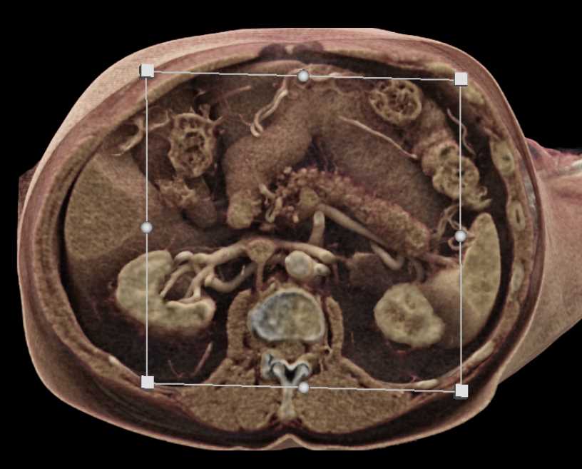 Adenocarcinoma of the Body of the Pancreas - CTisus CT Scan