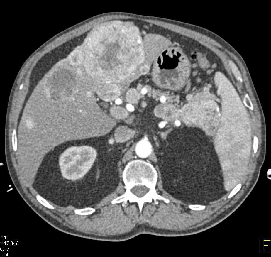 Pancreatic Neuroendocrine Tumor (PNET) Tail of Pancreas with Liver Metastases - CTisus CT Scan