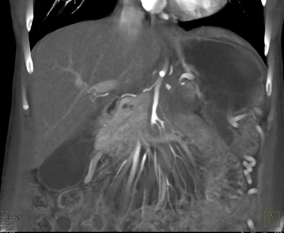 Adenocarcinoma Body of Pancreas with Vascular Encasement - CTisus CT Scan