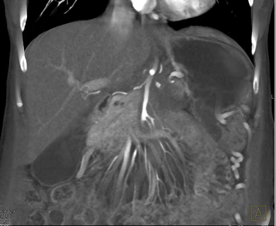 Adenocarcinoma Body of Pancreas with Vascular Encasement and Occlusion - CTisus CT Scan