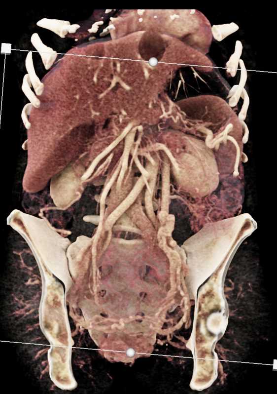 Adenocarcinoma Body of Pancreas with Vascular Encasement and Occlusion - CTisus CT Scan