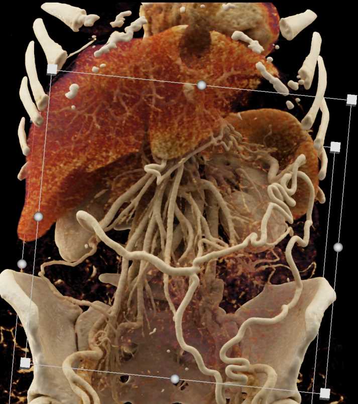 Adenocarcinoma Body of Pancreas with Vascular Encasement and Occlusion with Collaterals - CTisus CT Scan