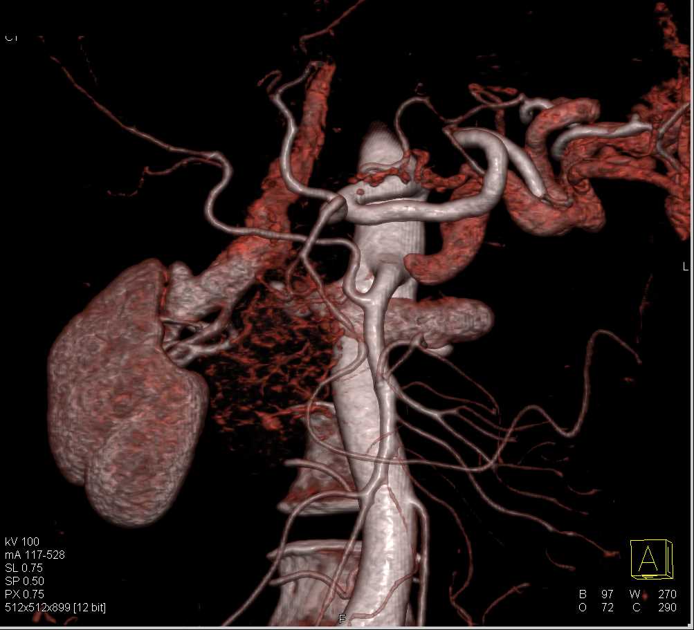 Pancreatic Cancer with Replaced Right Hepatic Artery off SMA and PV SMV Involvement - CTisus CT Scan