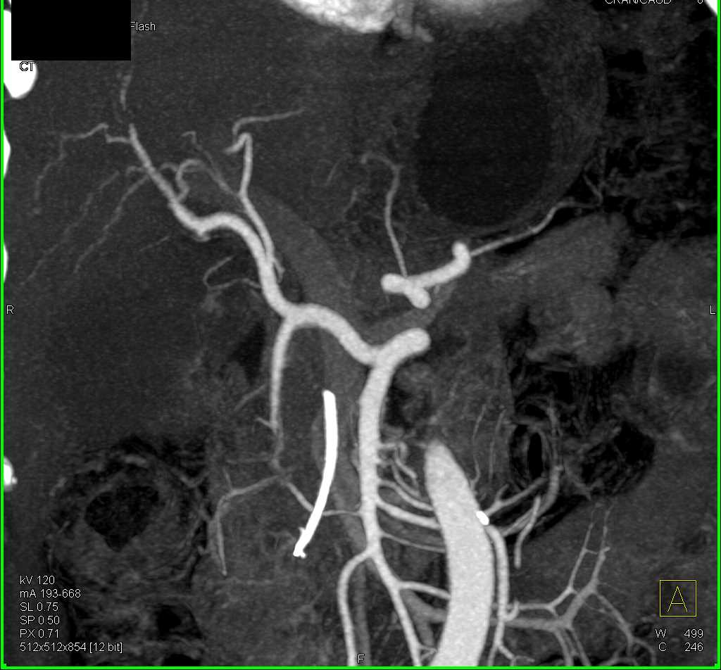 Pancreatic Cancer with Replaced Right Hepatic Artery off SMA and PV SMV Involvement - CTisus CT Scan