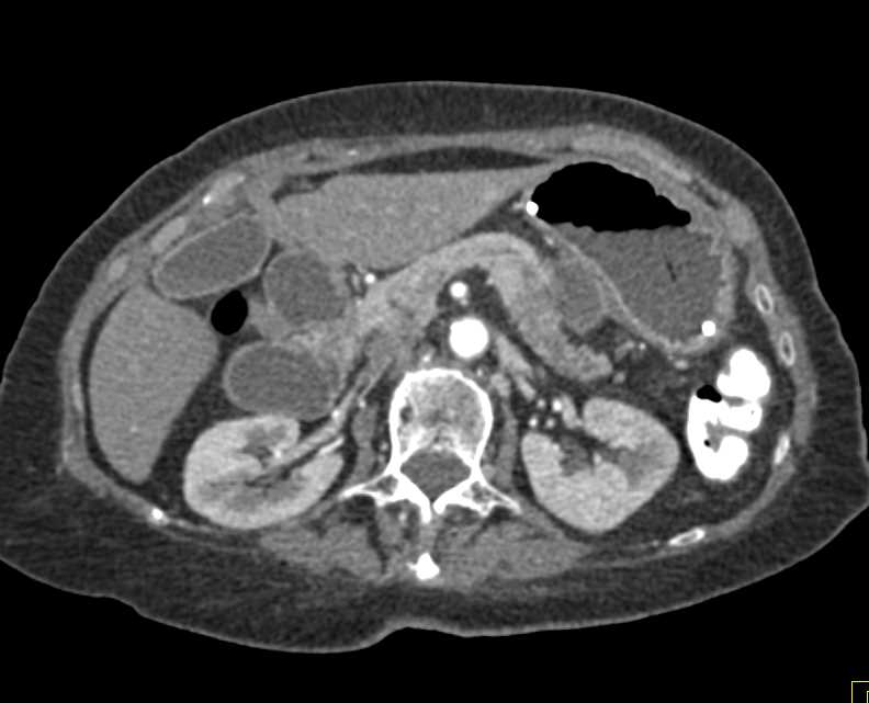 Carcinoma Tail of Pancreas - CTisus CT Scan