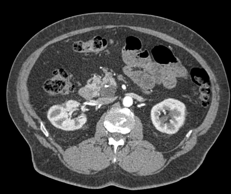 Serous Cystadenoma Head of Pancreas - CTisus CT Scan