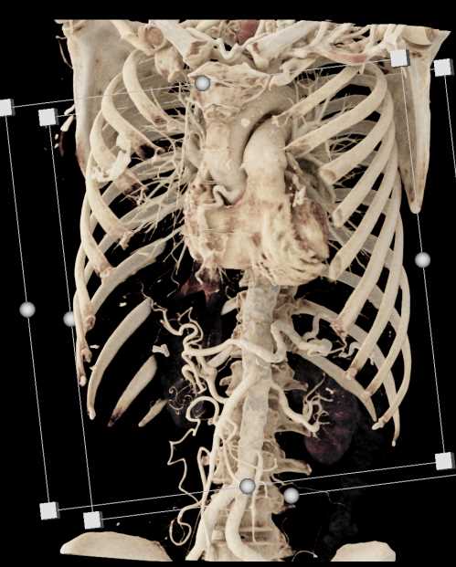 PNET Obstructs the Pancreatic Duct - CTisus CT Scan