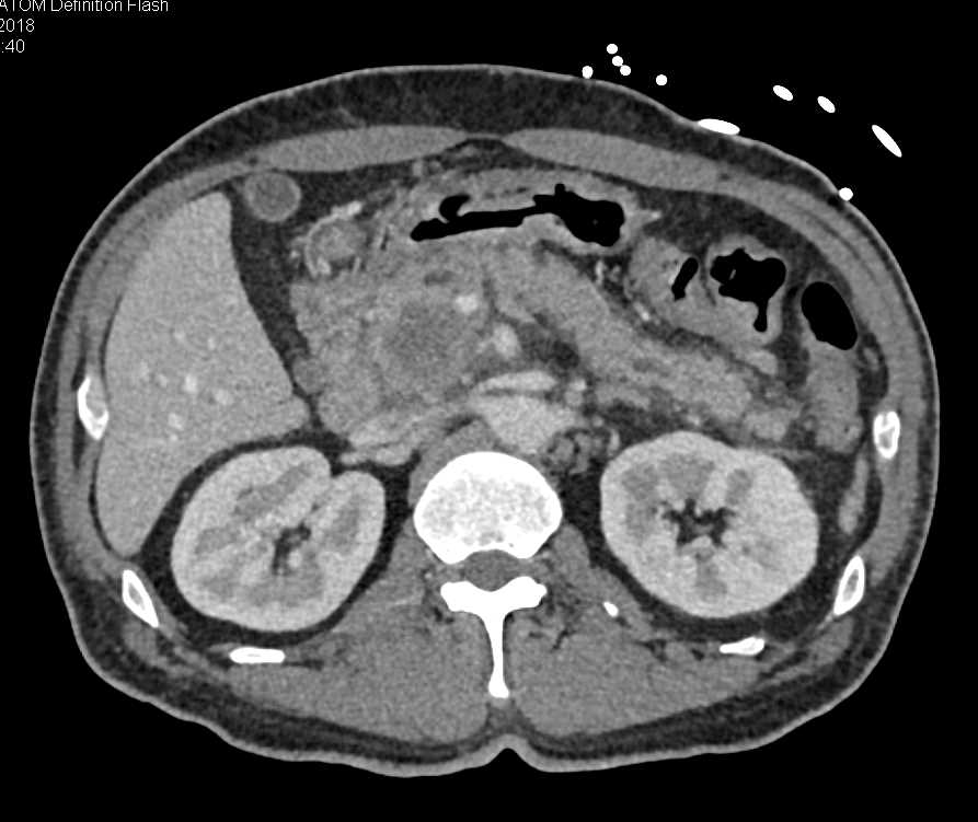 Pancreatic Adenocarcinoma - CTisus CT Scan