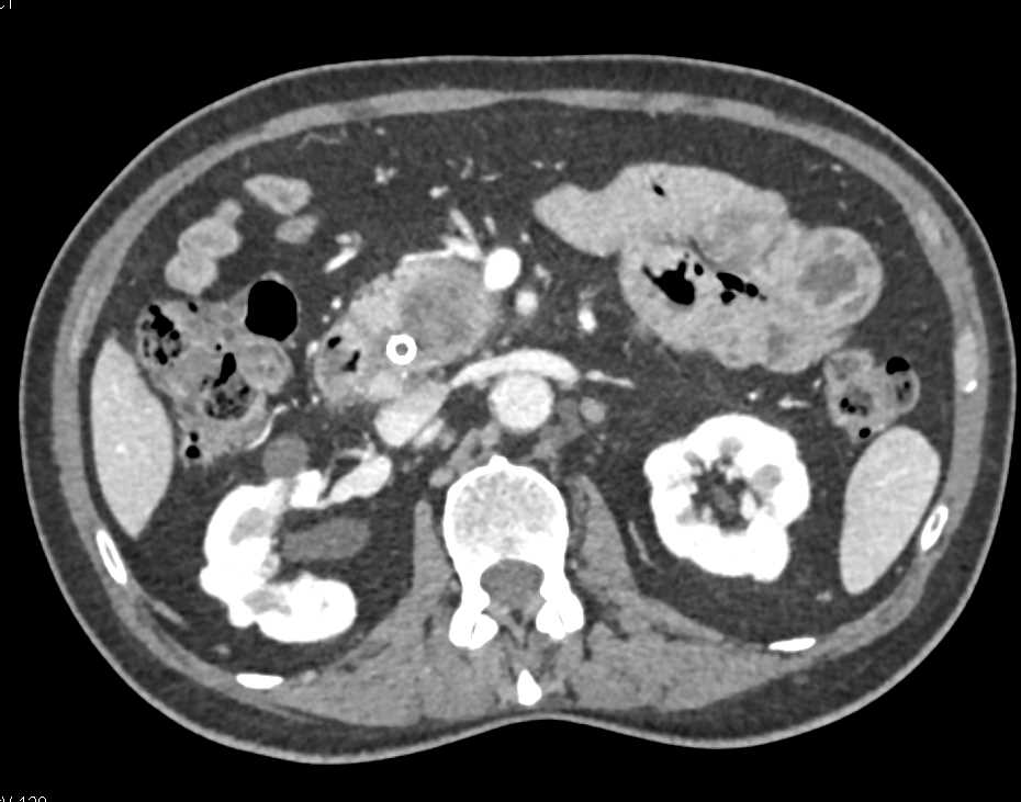 Carcinoma Head of Pancreas - CTisus CT Scan