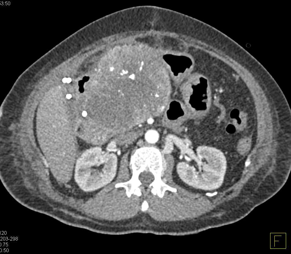 Serous Cystadenoma Head of the Pancreas - CTisus CT Scan