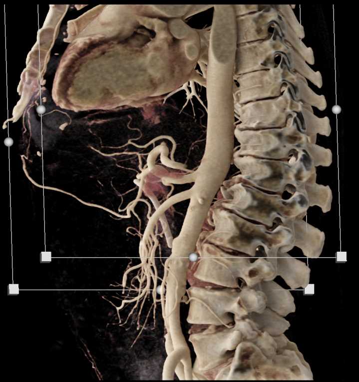 Pancreatic Cancer with Stent in the Common Bile Duct (CBD) with Vascular Map - CTisus CT Scan