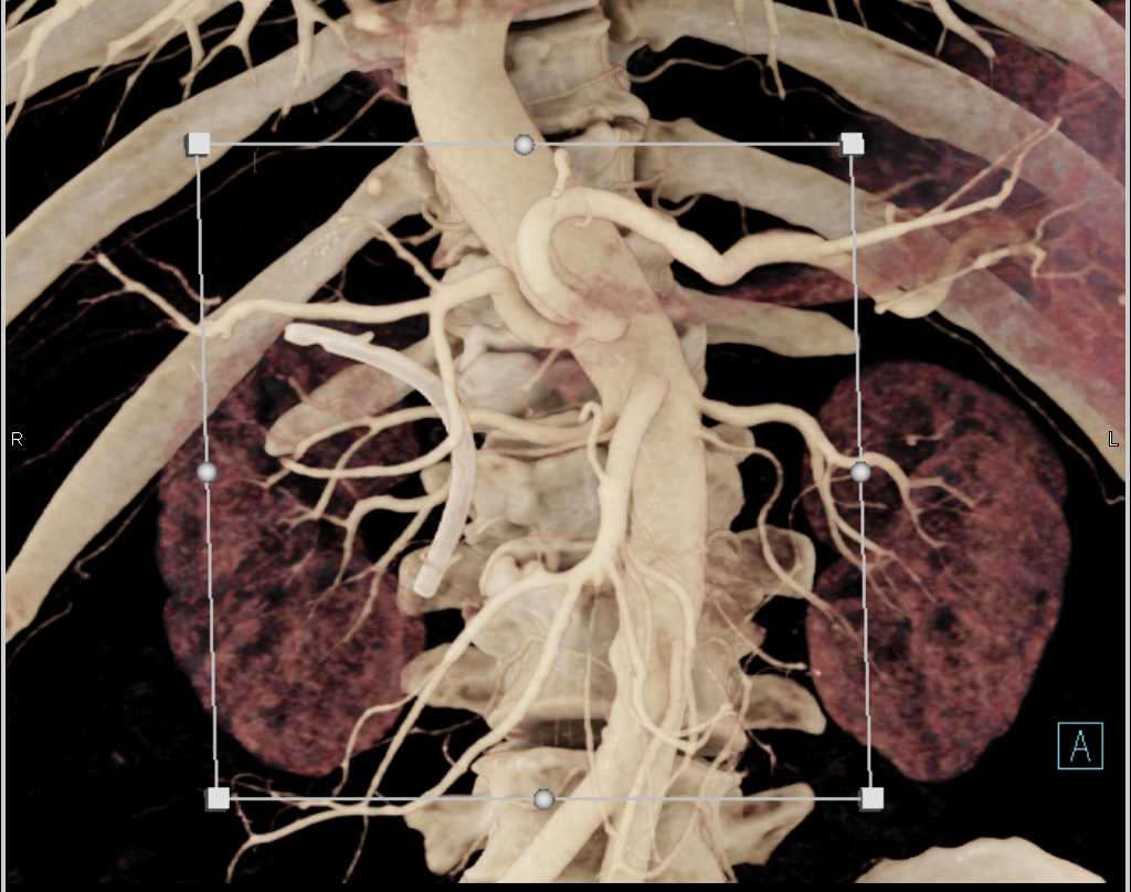 Pancreatic Cancer with Stent in the Common Bile Duct (CBD) with Vascular Map - CTisus CT Scan