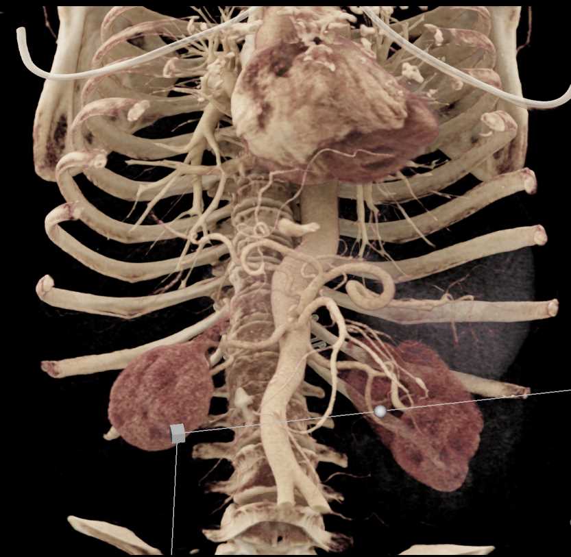 Pancreatic Pseudocysts - CTisus CT Scan