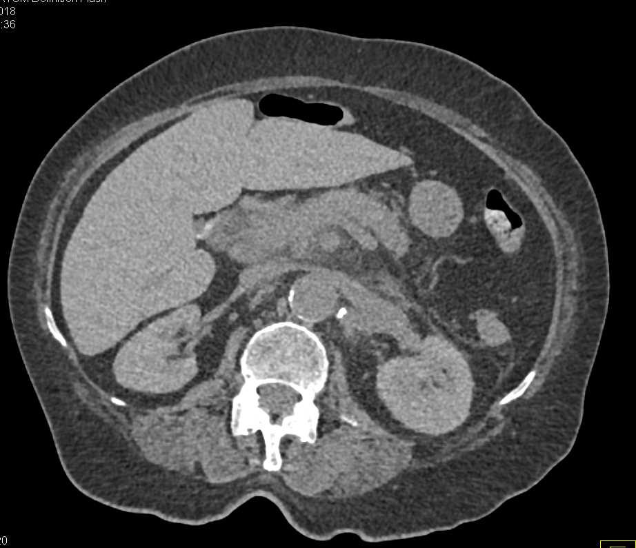 Pancreatitis with Suspected Pancreatic Mass - CTisus CT Scan