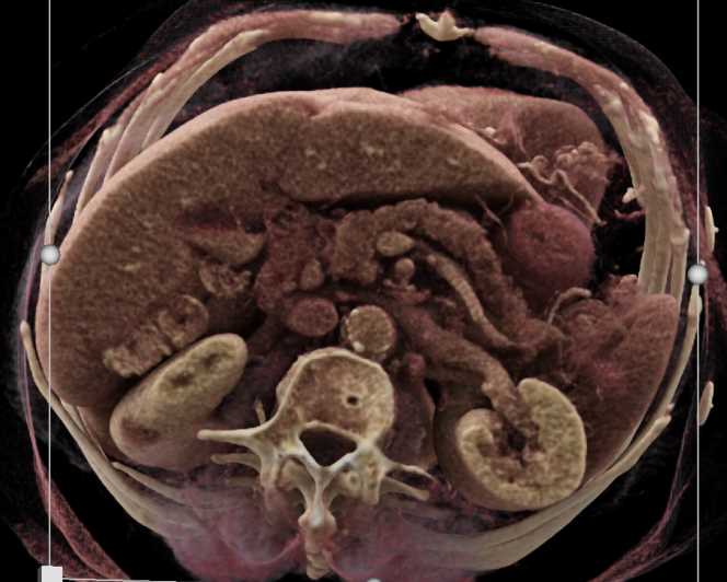 Subtle Carcinoma Head of Pancreas - CTisus CT Scan