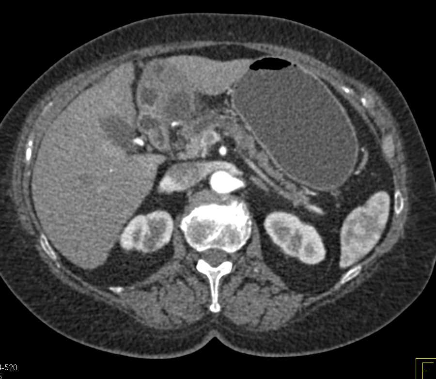 Cystic Adenocarcinoma Pancreas - CTisus CT Scan