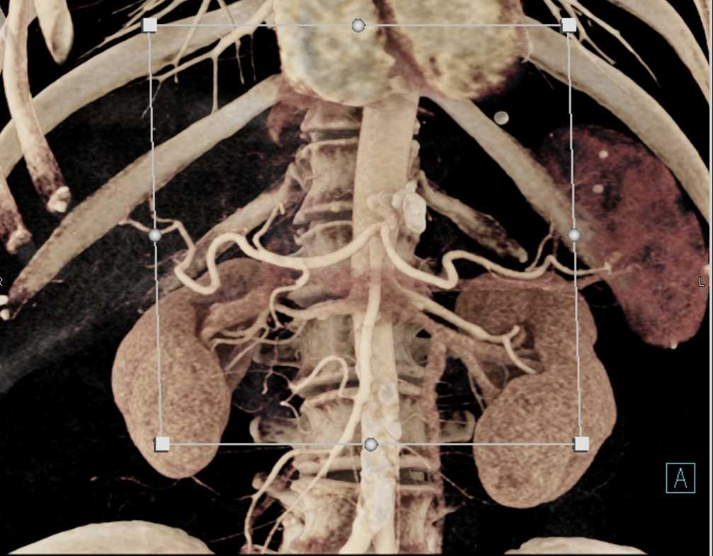 Pancreatic Cancer Encases the PV/SMV - CTisus CT Scan