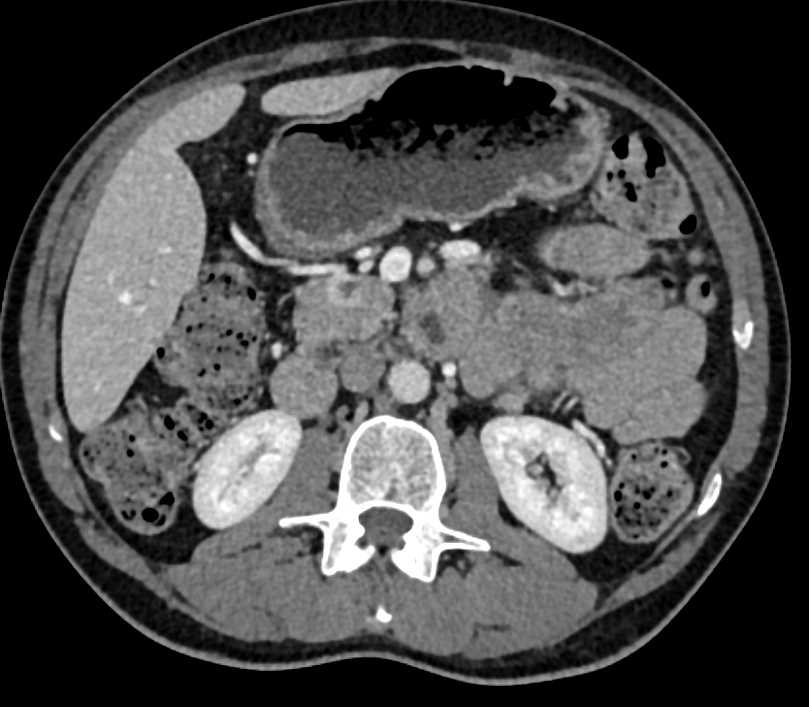 Pancreatic Neuroendocrine Tumor (PNET) Head of Pancreas - CTisus CT Scan