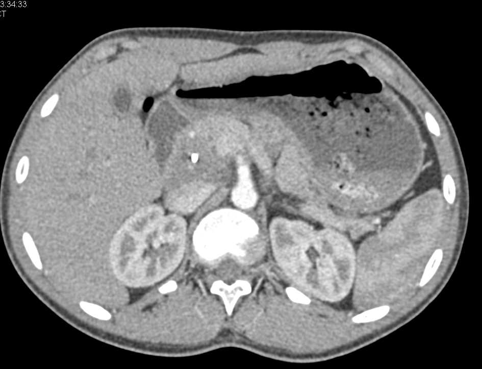 Pancreatic Cancer with Stent in Place - CTisus CT Scan