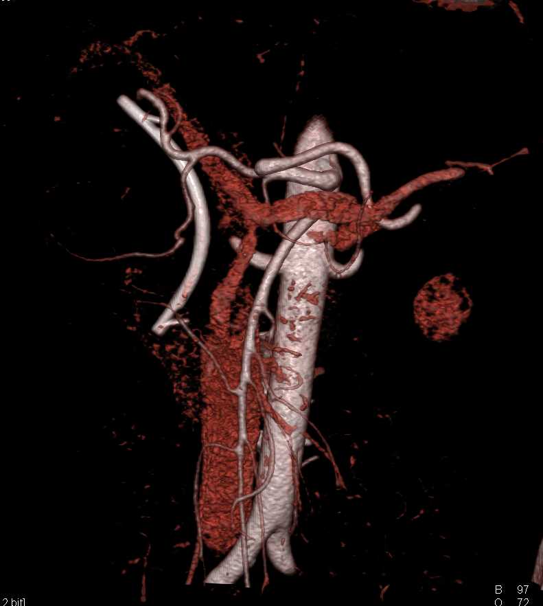 Pancreatic Cancer with Stent in Place in Common Bile Duct (CBD) and Liver Metastases - CTisus CT Scan