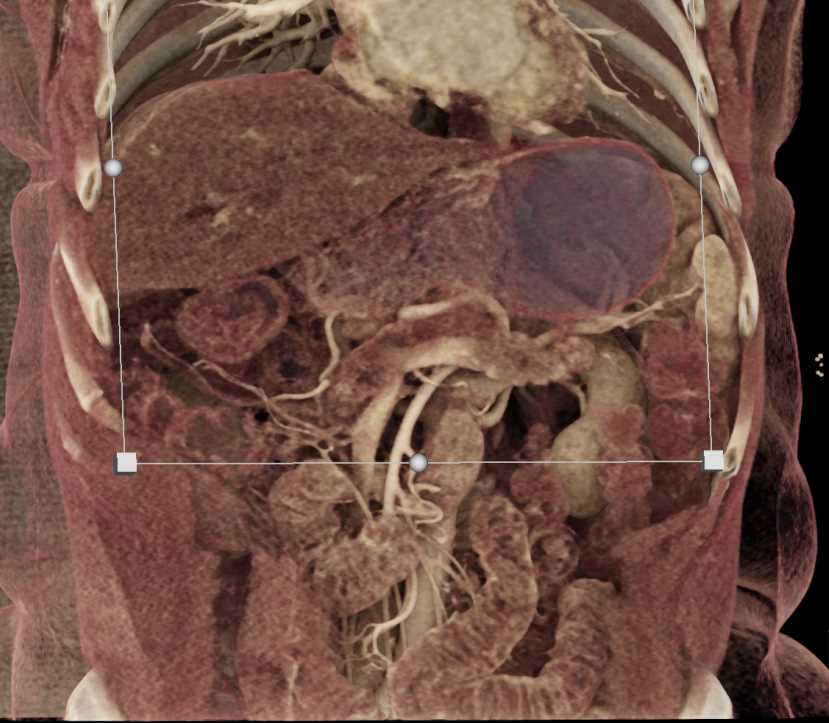 Pancreatic Cancer with Stent in Place in Common Bile Duct (CBD) and Liver Metastases - CTisus CT Scan