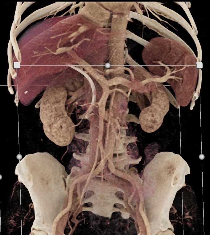 Pancreatic Cancer with Stent in Place in Common Bile Duct (CBD) and Liver Metastases - CTisus CT Scan