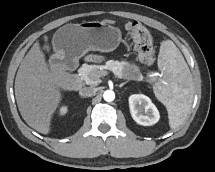 Carcinoma Tail of Pancreas - CTisus CT Scan