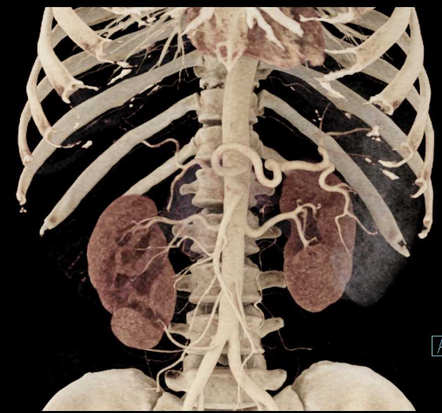 Carcinoma Tail of Pancreas - CTisus CT Scan