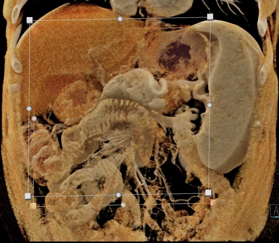 Carcinoma Tail of Pancreas - CTisus CT Scan