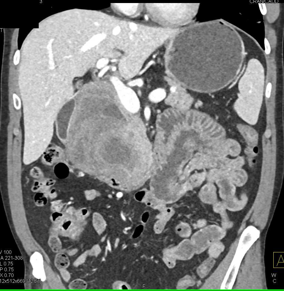 Solid Serous Cystadenoma - CTisus CT Scan