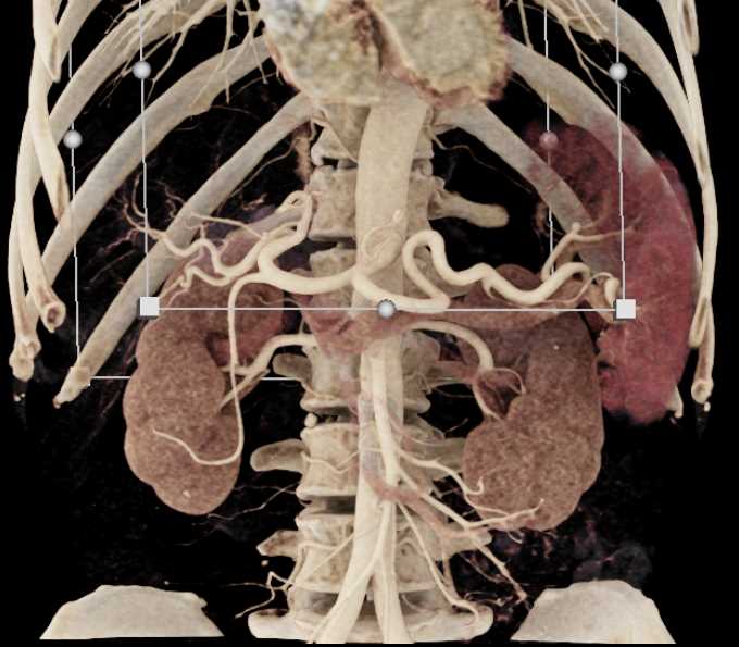 Solid Serous Cystadenoma - CTisus CT Scan