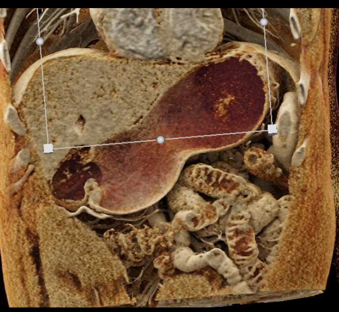 Solid Serous Cystadenoma - CTisus CT Scan