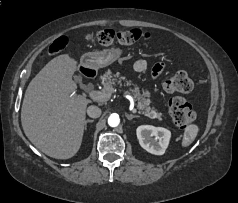 Neuroendocrine Tumor Tail of Pancreas - CTisus CT Scan