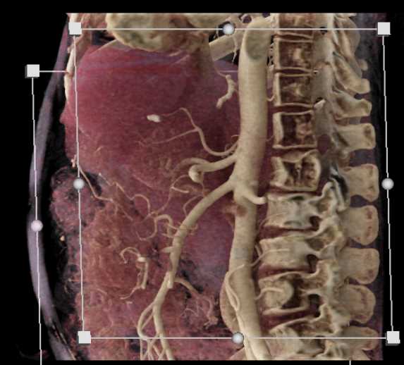 Neuroendocrine Tumor Tail of Pancreas - CTisus CT Scan