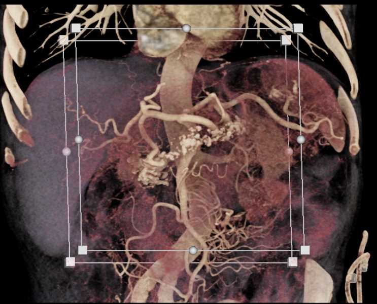 Chronic Pancreatitis - CTisus CT Scan