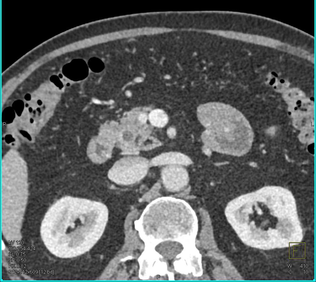 1cm PNET Head of Pancreas - CTisus CT Scan