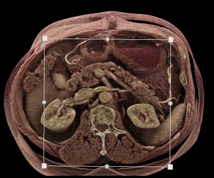 1cm PNET Head of Pancreas - CTisus CT Scan