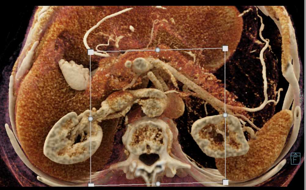 1cm PNET Head of Pancreas - CTisus CT Scan