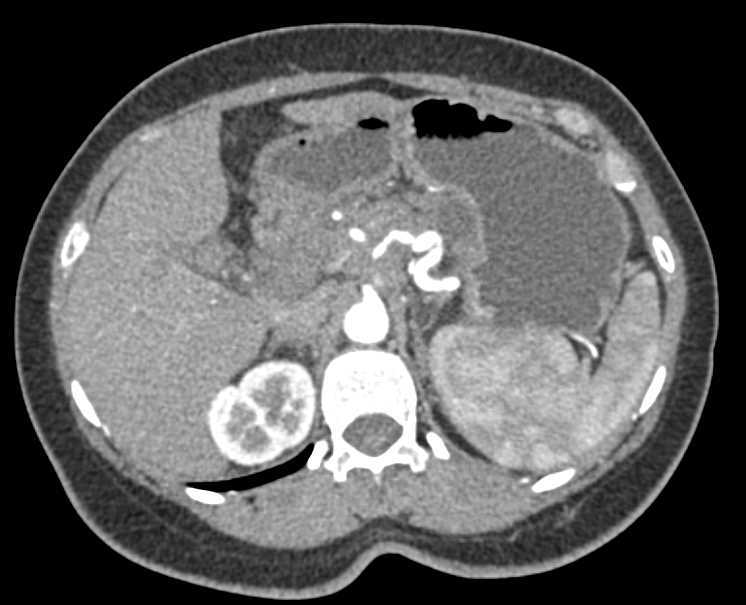 Carcinoma Body of Pancreas with Vascular Encasement - CTisus CT Scan