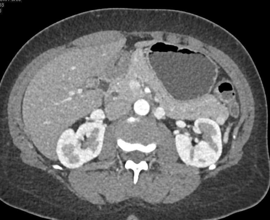 SMV Simulates a PNET - CTisus CT Scan